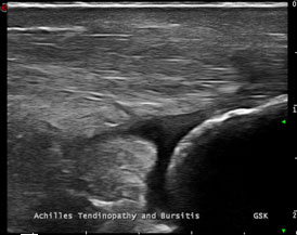 Achilles+tendonitis+ultrasound